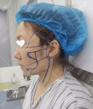 上海九院丁伟面部小切口拉皮手术30天恢复照片，花费8万多,童颜术对比照-8682赴韩整形网
