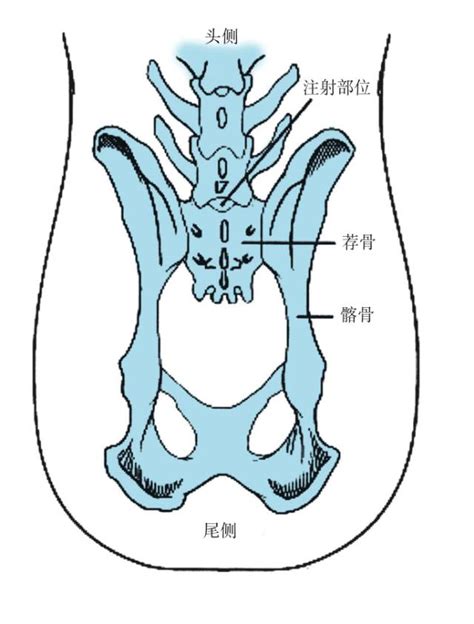 坐骨棘位置示意图图片