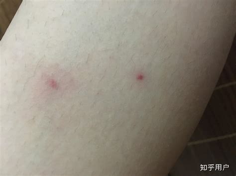 为什么我被蚊子叮了以后就留下一个红点点，永远消不掉……? - 知乎