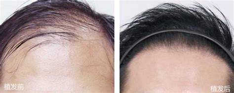 北京植发案例-种植头发-对比效果图-发友网