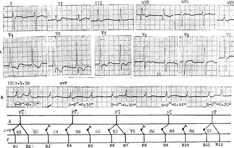 第232例 加速的交界性逸搏心律引起交替性室房传导及交替反复心搏-心血管-医学