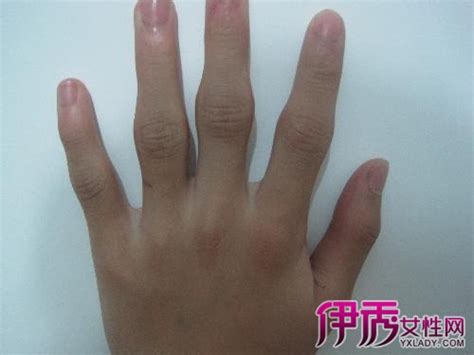 手指甲发紫是怎么回事的原因图片及治疗护理