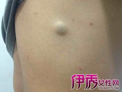 皮肤囊肿图片