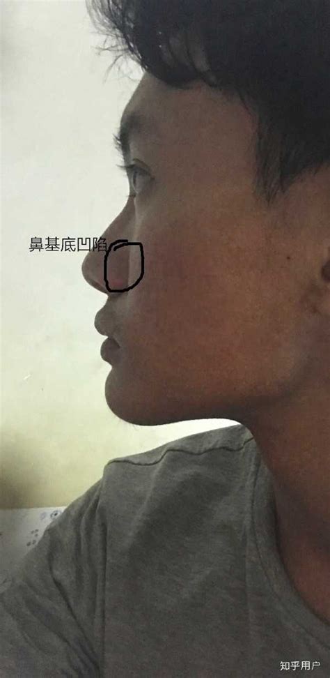 男生有必要整容鼻子吗?鼻综合前后案例对比照片效果自然吗,鼻部整形-8682赴韩整形网