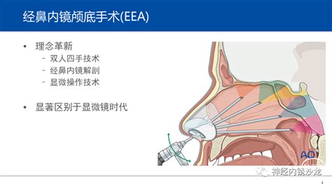 脑脊液鼻漏图片