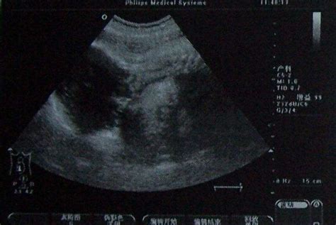 一文详解孕期B超单图像看法，是男是女看这几个数据就知道_家庭医生在线