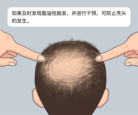 医生给中年大叔治疗秃头高清图片下载-正版图片501661482-摄图网