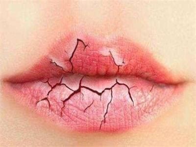 嘴唇干裂是什么原因?脱皮应该怎么办_360新知