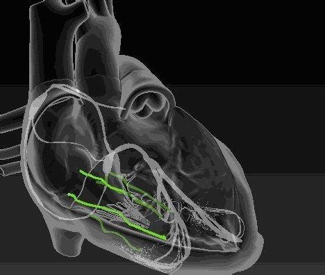 各种心脏起搏器有啥不一样？心内科专家一一对比