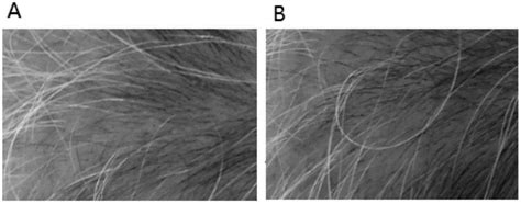 脐带间充质干细胞因子复合物在促进头发再生中的应用的制作方法