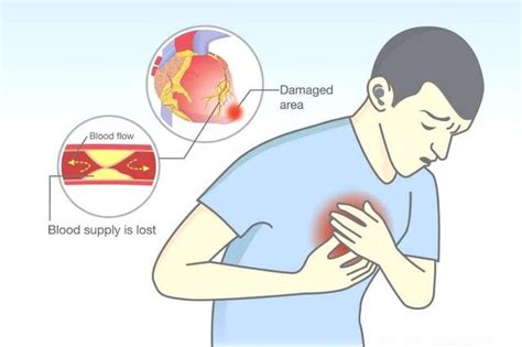 专家教您如何正确识别胸痛和心绞痛|心绞痛|胸痛|专家|部位|诱因|缓解|-健康界