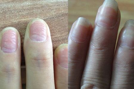 指甲竖纹多是癌症 一是指甲甲母部位出现了一种色