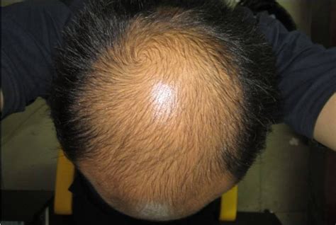 科学家提出治疗秃顶新方法：向头部注射自己血液--中国数字科技馆