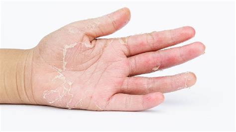 手癣怎么治疗才能除根？手癣的症状图片你看过吗？-手癣治疗-复禾健康