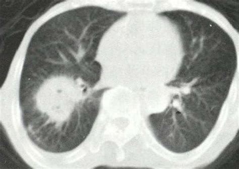 谈谈肺癌中的“老二”——肺鳞癌的病因，以及治疗上的新方法 - 知乎