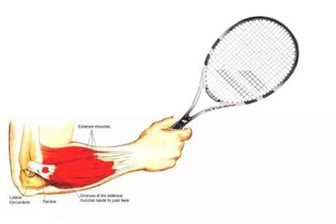 网球肘【多图】_39医疗图集-39健康网