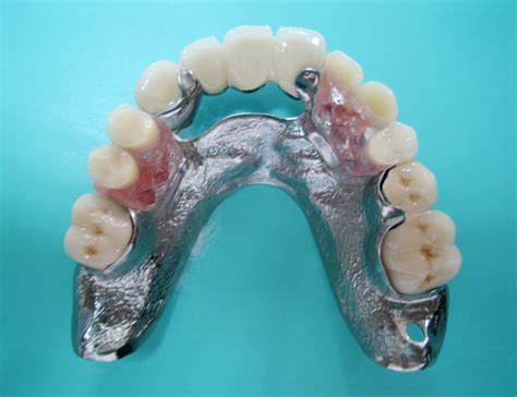钢托-活动义齿-假牙网