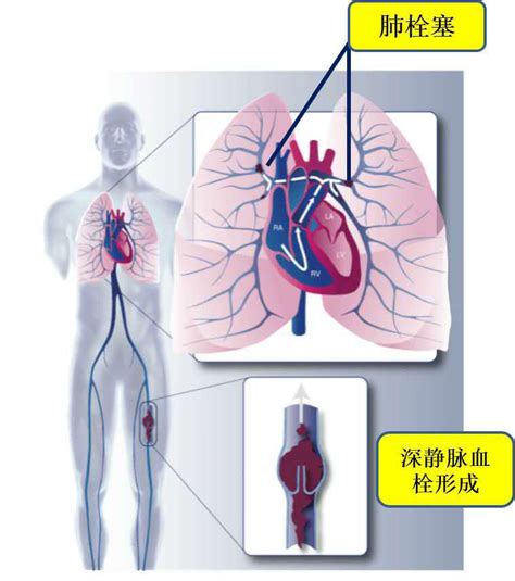 呼吸内科VTE的预防和护理ppt课件_PPT牛模板网