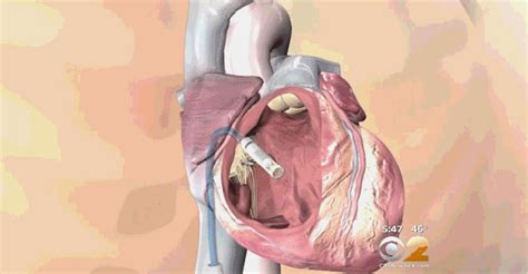 心脏起搏器类型,三腔,有(第5页)_大山谷图库