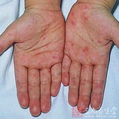 轻微手足口病图片