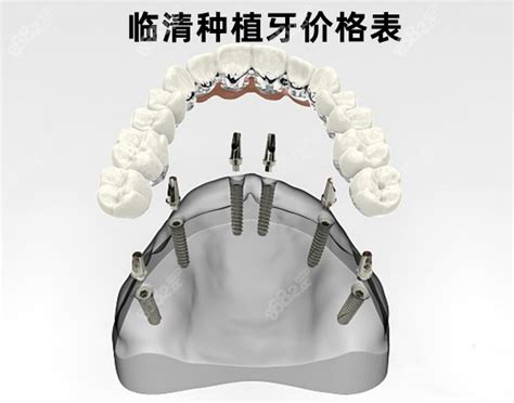 广州曙光口腔免费种牙活动真的来了,半全口种植牙也有降价,种植牙-8682赴韩整形网