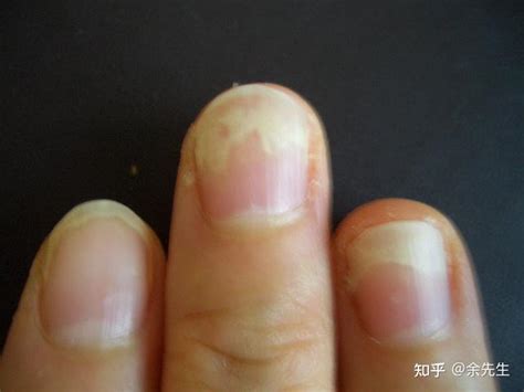 “灰指甲”会造成哪些伤害？这四点重视起来，正确预防！__凤凰网