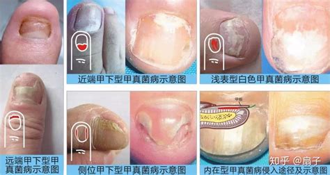 灰指甲症状图片是什么样子_灰指甲_北京京城皮肤医院(北京医保定点机构)
