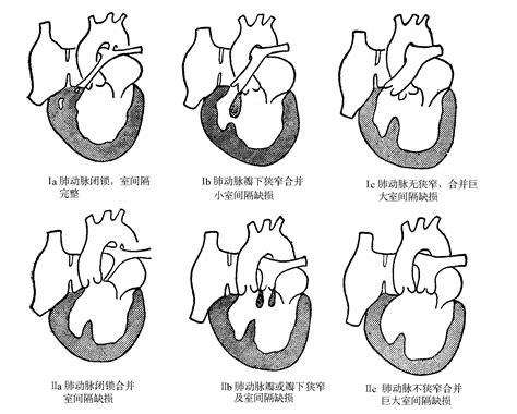 图27-1 三尖瓣闭锁的类型-心血管-医学