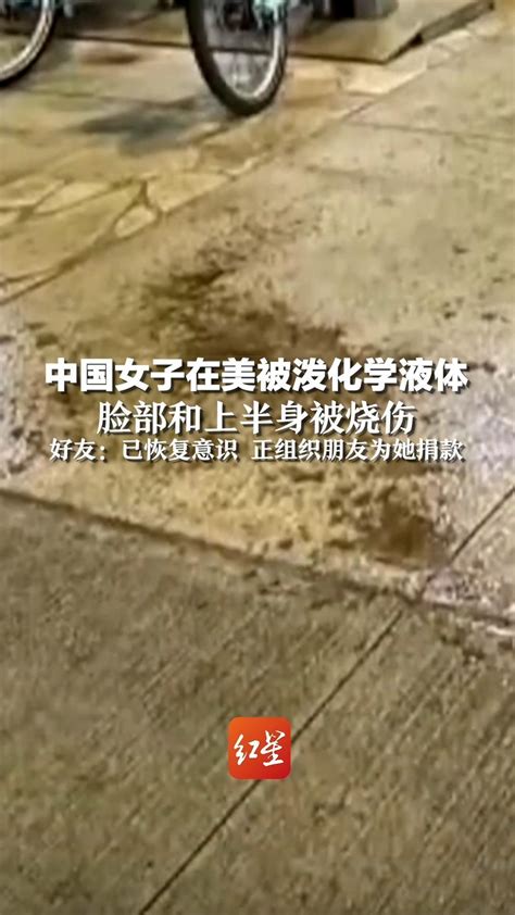 中国女子在美被泼化学液体，脸部和上半身被烧伤，好友：已恢复意识 正组织朋友为她捐款_凤凰网视频_凤凰网