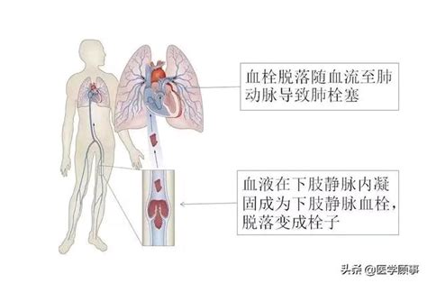 下肢静脉血栓图片