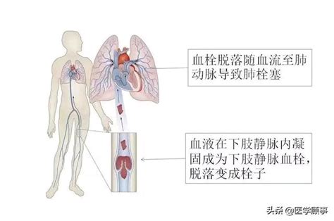 下肢静脉血栓治疗方法有哪些_39健康网_精编内容