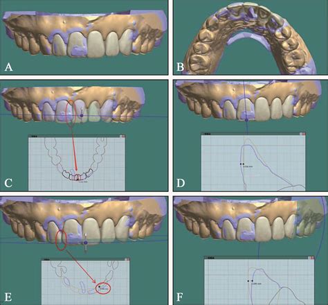 数字口腔数据重建的三维打印牙科模型的准确性如何_中国3D打印网