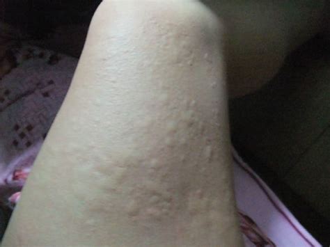 荨麻疹是什么原因引起的 怎么根治湿疹-中华银屑病网