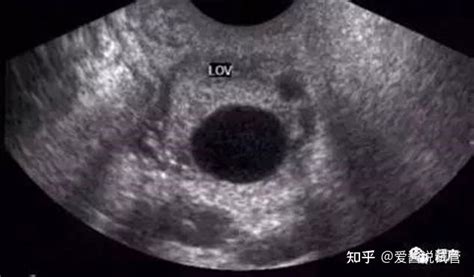 2007剖腹產，2014年4月20日末次月经，B超宫内早孕，但左附件有5.5*4.1cm团块 求解 - 百度宝宝知道