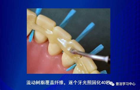 牙周夹板固定图片