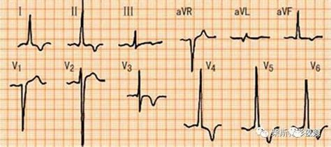 心电图T波低平、T波倒置，就是心脏病吗？_复查