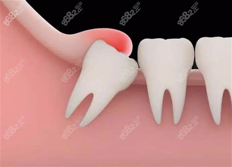 什么叫半固定种植牙?和全固定区别之一是牙冠能不能拿下来 - 口腔健康 - 毛毛网