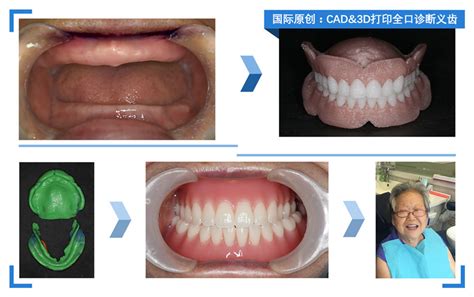 口腔医院首次应用自主研发的3D打印技术成功完成无牙颌全口义齿修复_北医新闻网