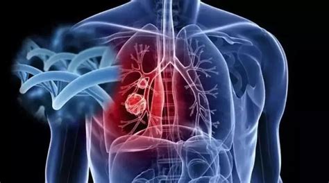 带您解读肺磨玻璃结节手术方式专家共识 - 微医（挂号网）