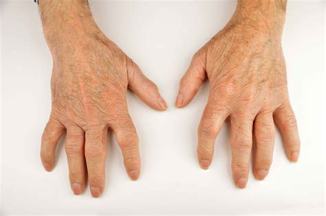 手上有青筋，或隐藏疾病，手部这4个部位有青筋，要注意|青筋|手部|部位_新浪新闻