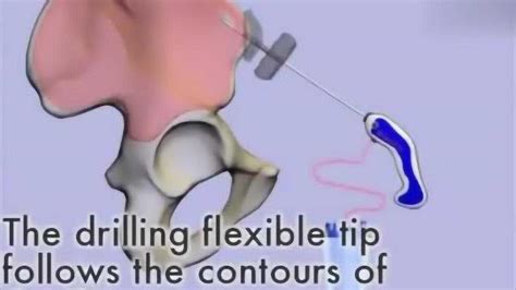 3D动画演示告诉你骨髓移植是怎么进行的，这画面不忍直视