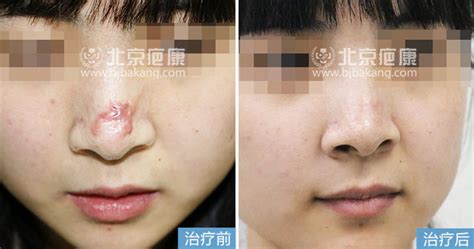 脸上20年的烧伤疤痕的治疗方法_北京疤痕医院_瘢痕修复_疤痕治疗_北京疤康医院【官】