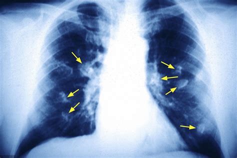 肺部阴影是怎么回事 - 专家文章 - 复禾健康