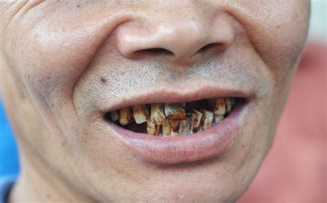 黑牙形成的原因有哪些？_漳州卫生职业学院附属口腔医院
