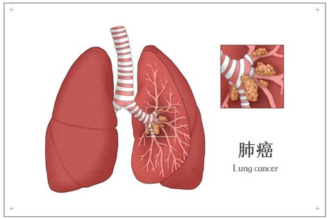 肺癌的介入治疗