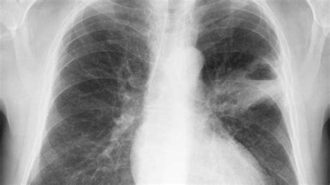 肺鳞癌是怎么发生的？怎样早期发现？医生教你看CT片|新冠肺炎_新浪新闻