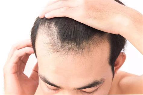遗传性脱发怎么办？预防脱发的方法都有什么？__凤凰网