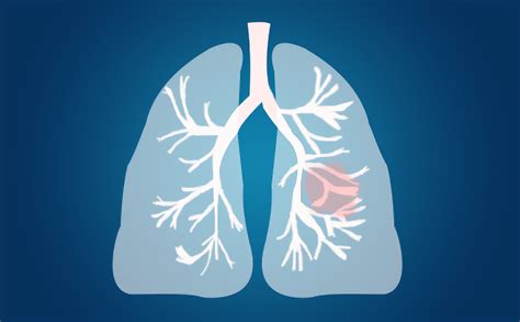 IASLC肺癌分期项目:为第九版TNM肺癌分类修订提供信息的新数据库 - 知乎