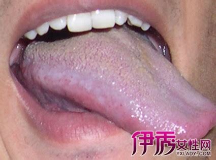 口腔白斑病图片