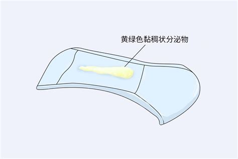 血性分泌物图片